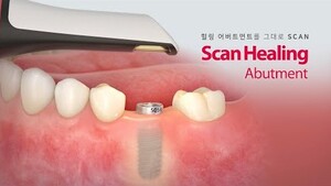 “힐링 어버트먼트와 스캔 바디 기능을 하나로”... Scan Healing Abutment < 핫클립 < 기사본문 - 덴탈아카이브(dentalarchive)